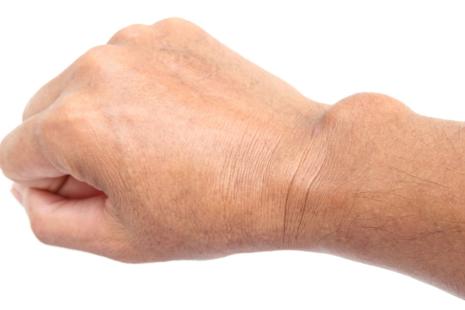 Ganglion cyst