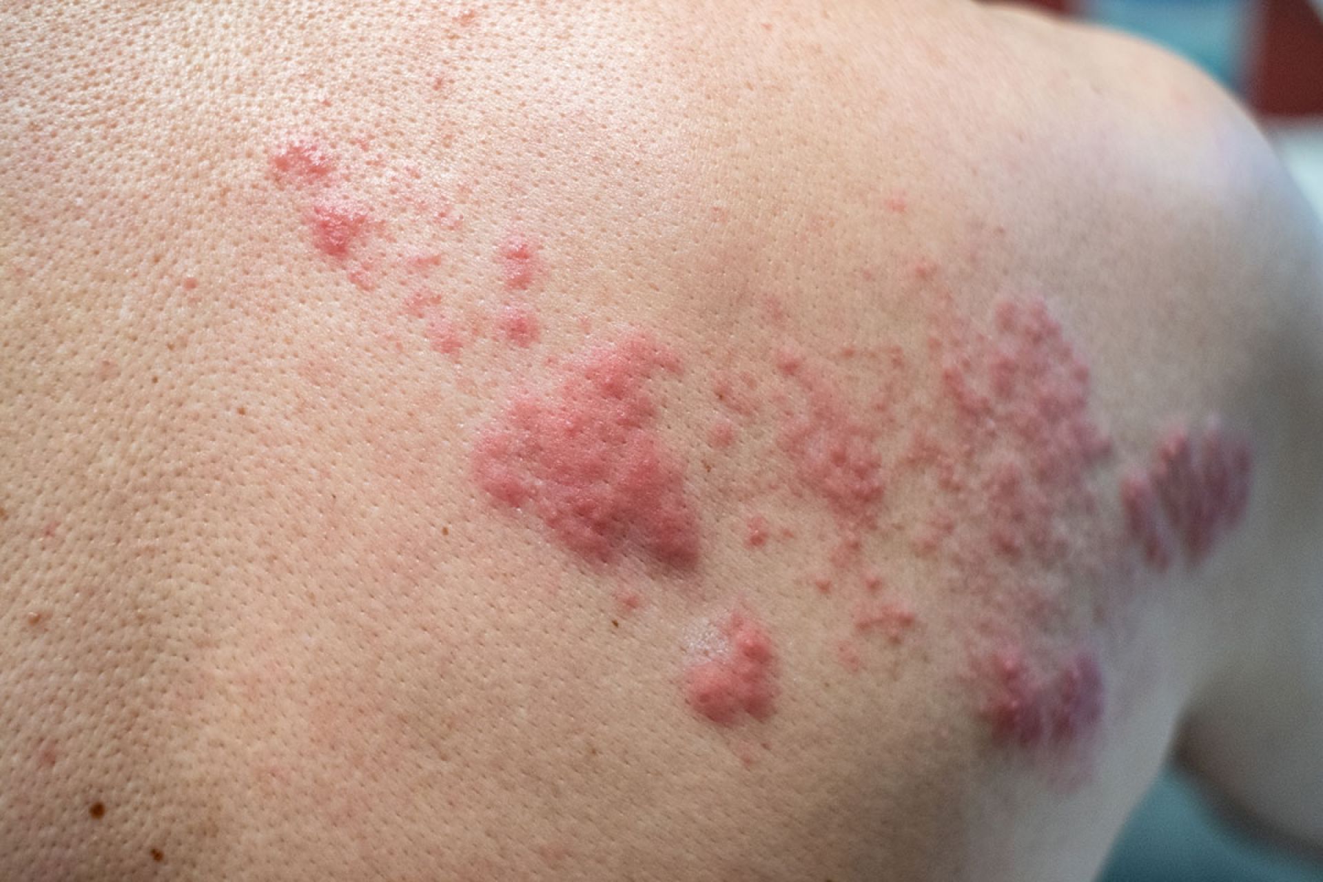 Herpes zoster