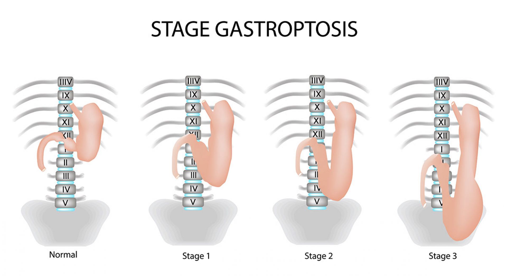 Gastroptosis
